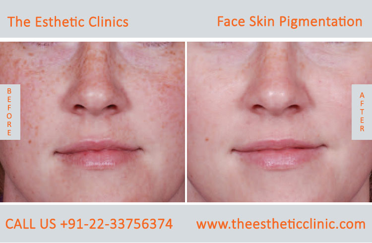 Face Skin Pigmentation Laser Treatment before after photos in mumbai india (2)